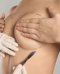 Everything You Should Know About Breast Augmentation From Consultation to Recovery image 3