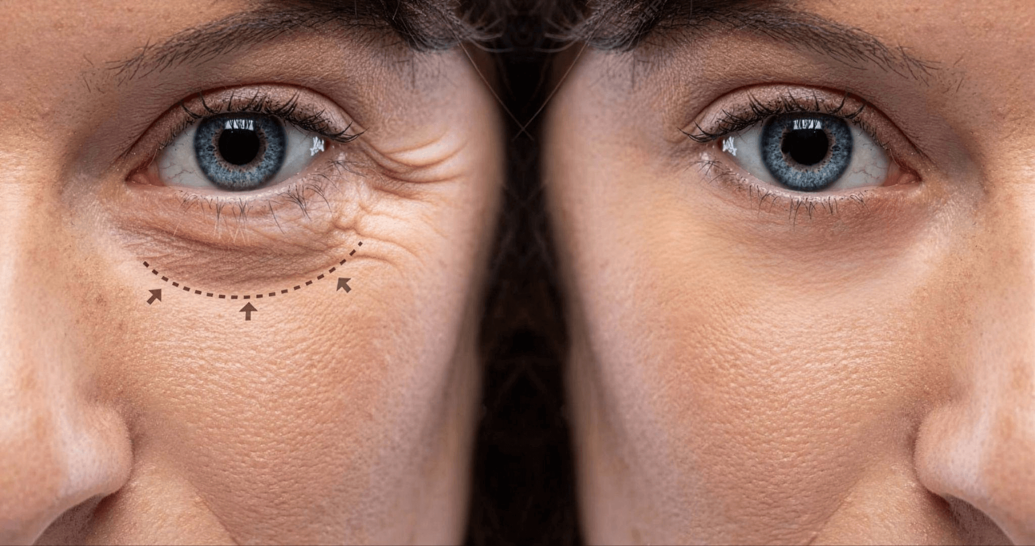 Eyelid Surgery Singapore: Enhancing Aesthetics and Restoring Youthful Eyes