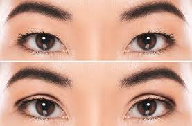 Eyelid Surgery Singapore Enhancing Aesthetics and Restoring Youthful Eyes image 3