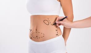 The Complete Guide to Liposuction Singapore What to Expect Before and After image 4