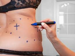 The Complete Guide to Liposuction Singapore What to Expect Before and After image 5